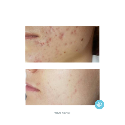 TCA 15% Gel Peel - Level 2 Enhanced with salicylic acid - pH 1.7-2.0
